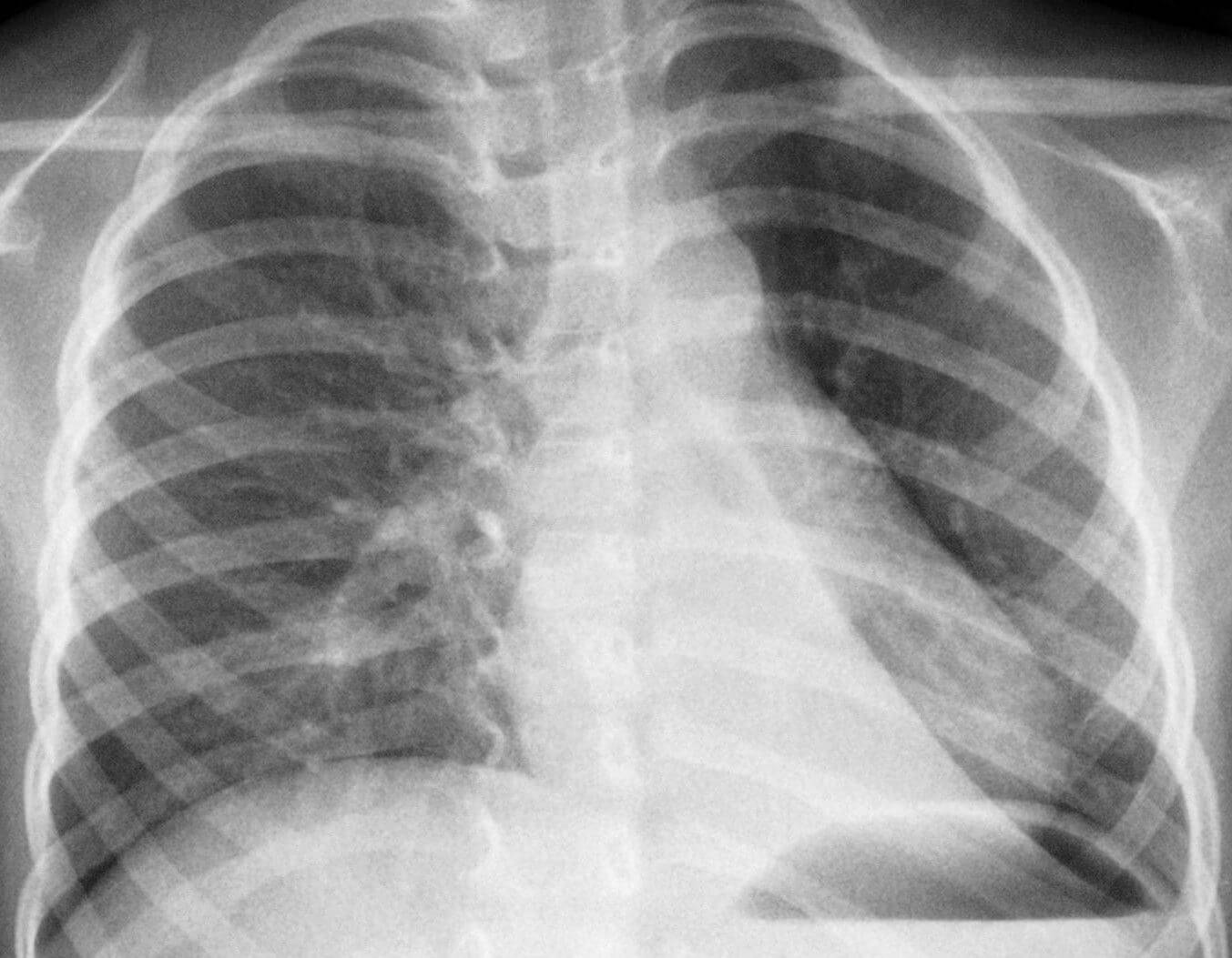 Первый признак воспаления легких у детей и взрослых: симтпомы пневмонии легкой формы, рентгенологические