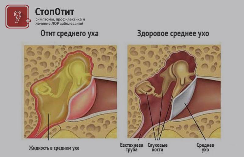 Как лечить воспаление уха