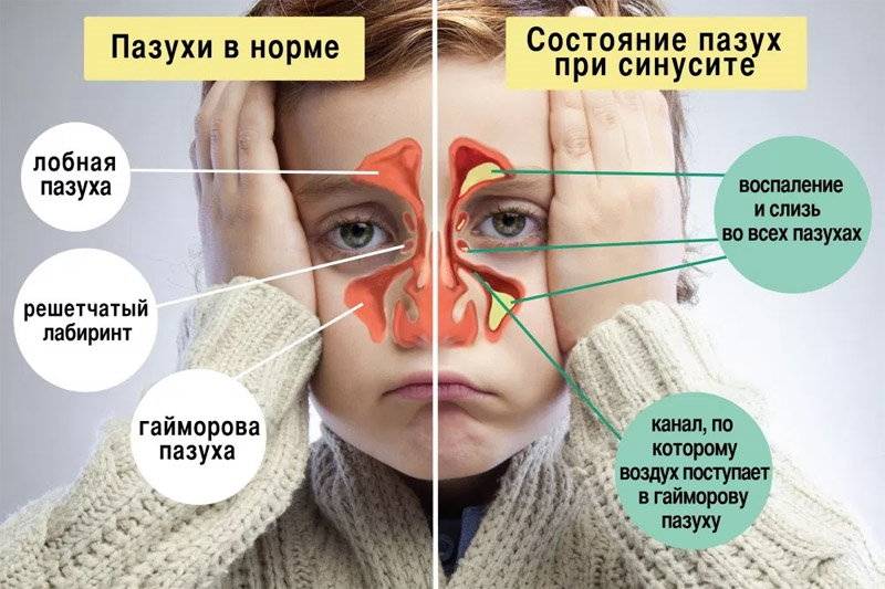 Заложен нос, но насморка нет у ребенка, возможные причины и методы лечения
