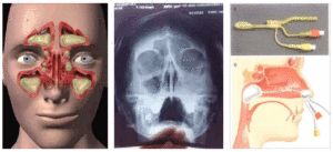Пункция пазух носа при синусите: рекомендации по носовому проколу от лор-врача
