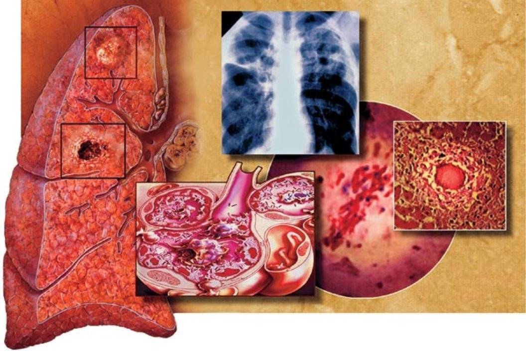 Какие формы и виды туберкулеза легких существуют: классификация и стадии