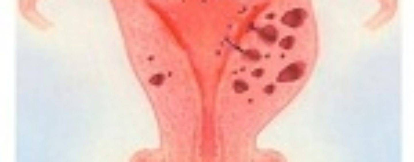 Миома матки и эндометриоз: диагностика и лечение в москве – многопрофильный лечебно-диагностический центр allergyfree