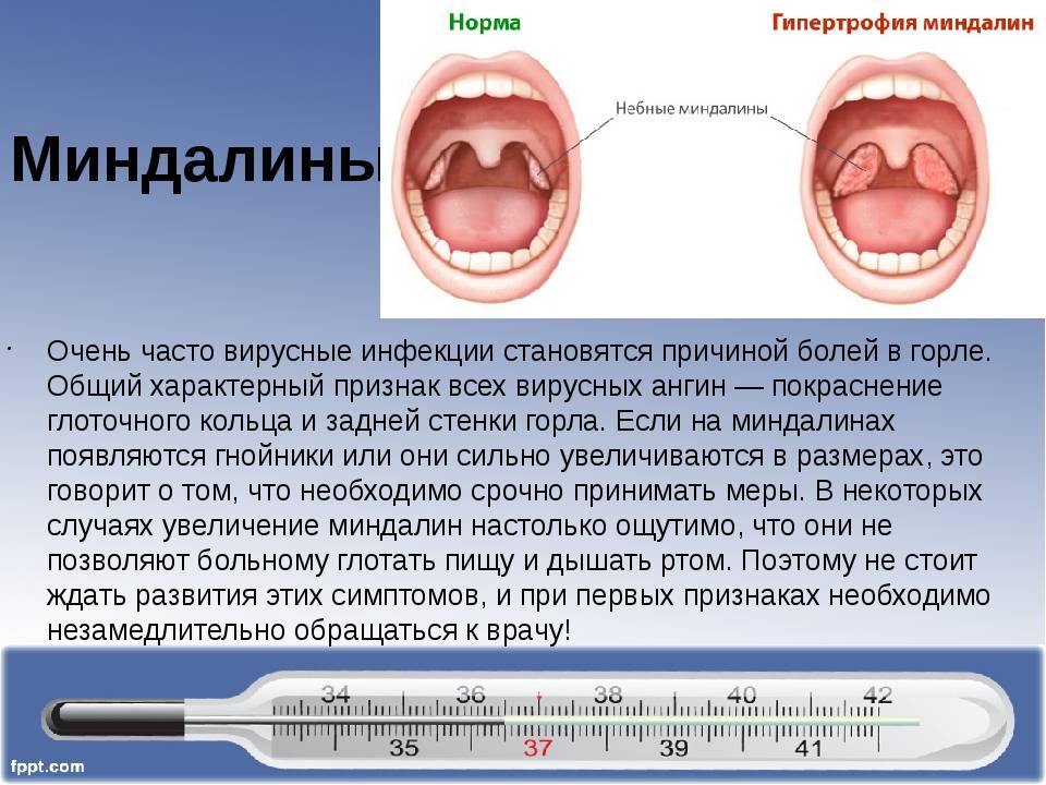 Ангина мкб 10 — классификация тонзиллита - горлонос.ру