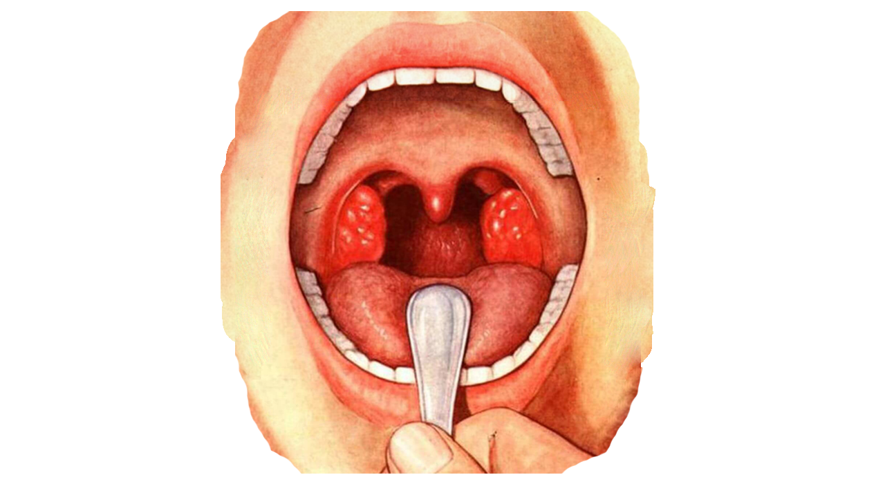 Профилактика тонзиллита, узнайте, чем полоскать горло для профилактики тонзиллита?