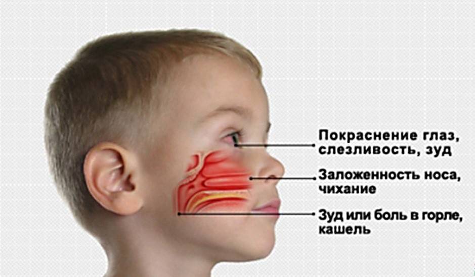 Постоянная заложенность носа без насморка: причины и лечение, что делать как лечить?