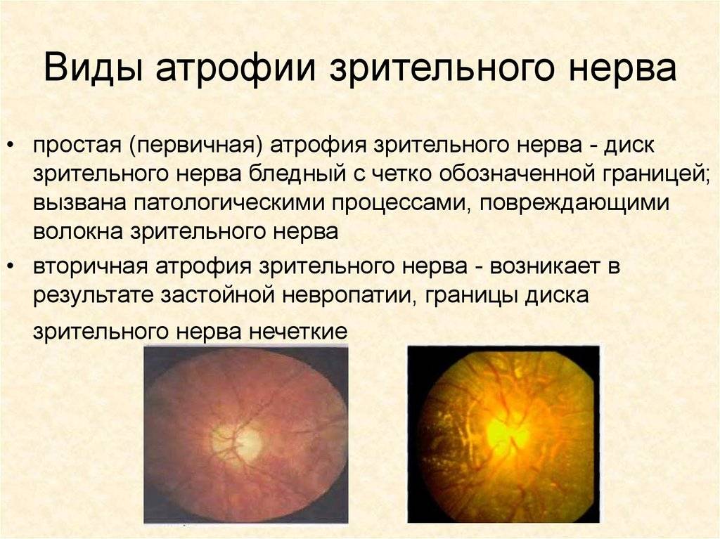 Атрофия зрительного нерва - что это, причины, симптомы и лечение