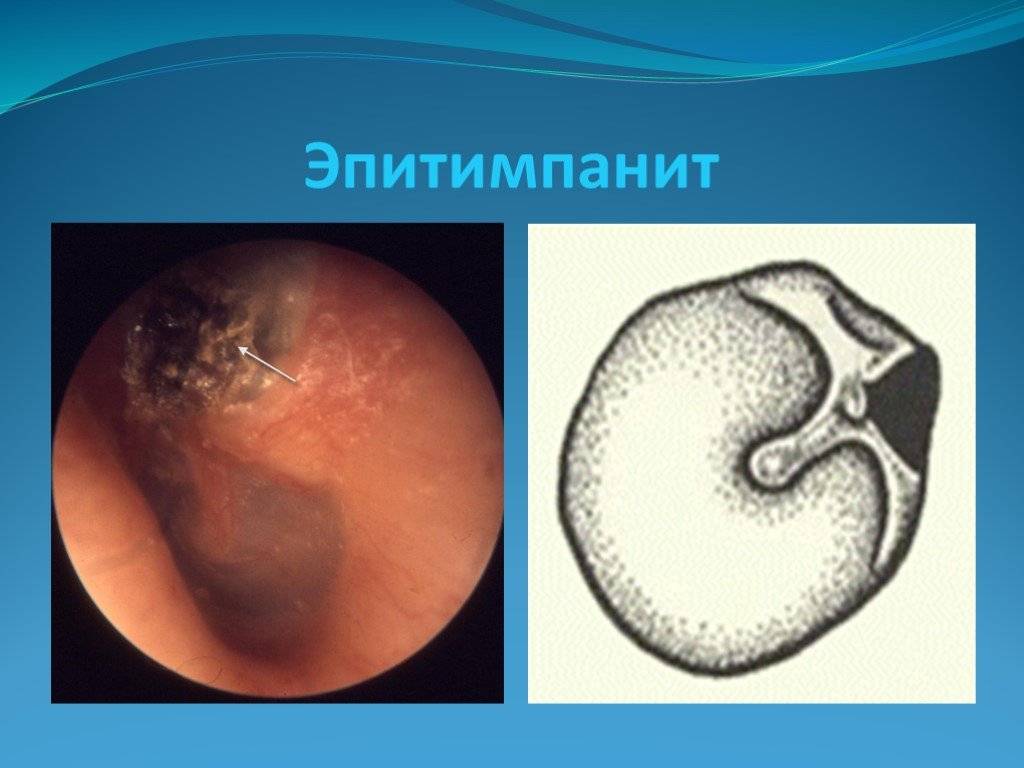 Отит - мкб-10 код, острый и катаральный у детей и взрослых, хронический, наружный, экссудативный среднего уха