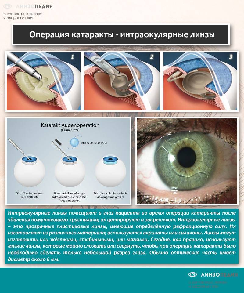 Лечение катаракты глаза народными средствами без операции в домашних условиях - современные способы как вылечить катаракту медом и укропом
