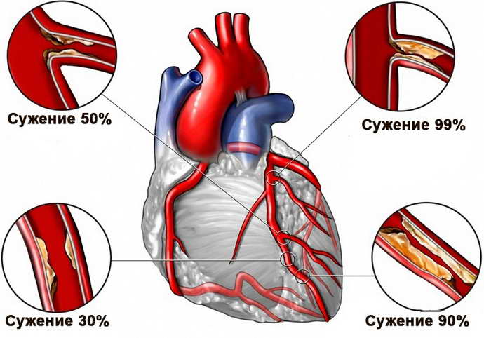 Стенокардия и инфаркт миокарда: диагностика, способы лечения и профилактики