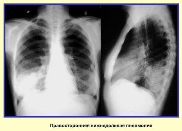 Правосторонняя пневмония: причины воспаления легких справа, лечение верхнедолевой и нижнедолевой пневмонии