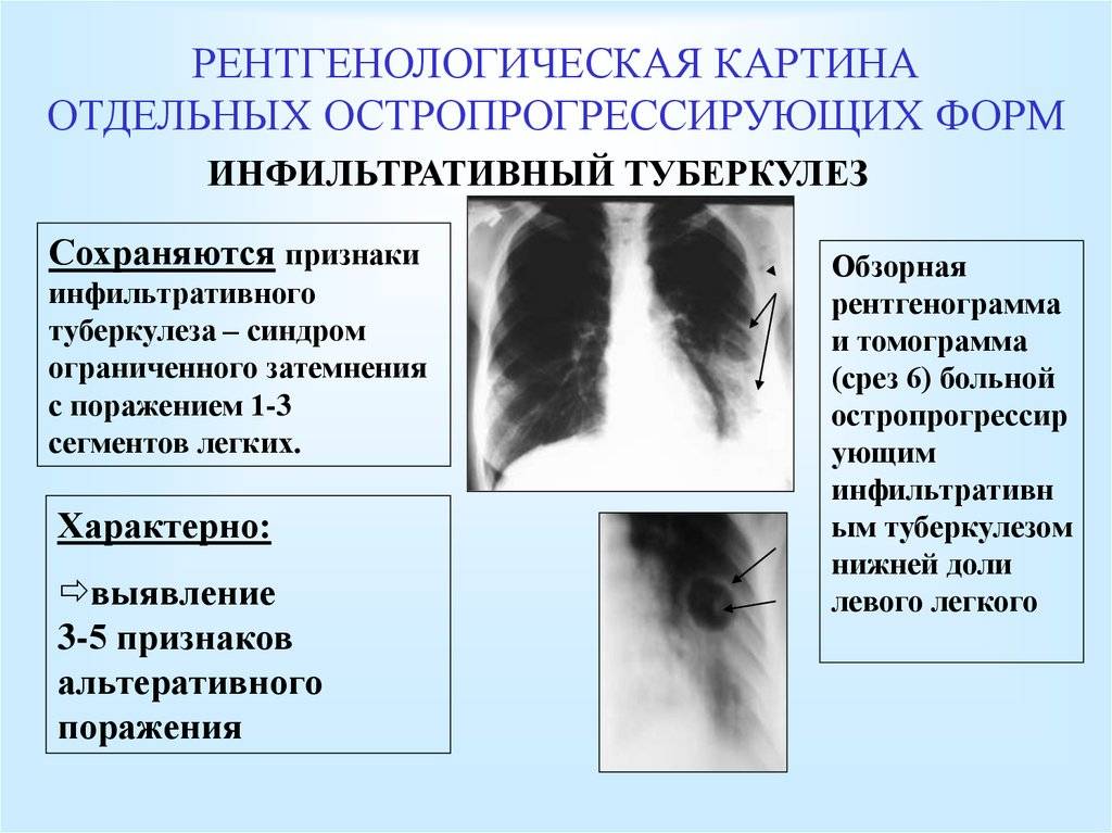 Диссеминированный туберкулез легких: фазы инфильтрации и распада, заразен он или нет, рентген, код по мкб-10, диагностика острой, подострой и хронической формы