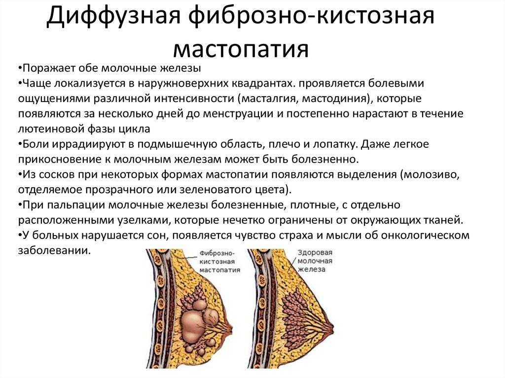 ᐉ народные методы лечения мастопатии при климаксе - sp-medic.ru