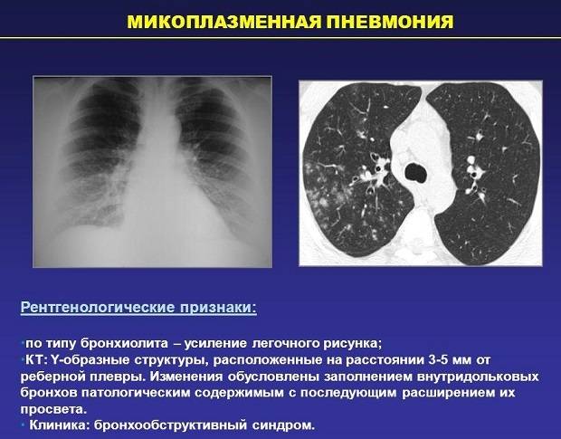 Микоплазменная пневмония: симптомы и лечение