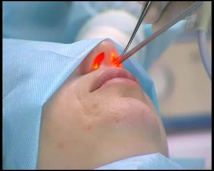 Лазерная операция на перегородке носа: виды и отзывы