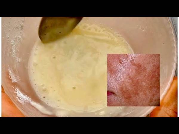 Домашние рецепты отбеливающих масок для кожи лица от пигментных пятен
