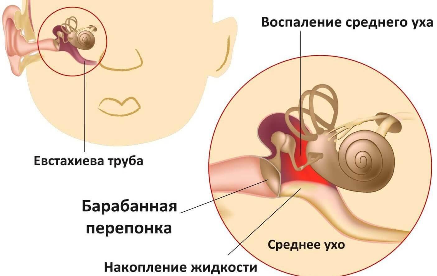 Воспаление среднего уха: развитие, симптомы, диагностика, лечение