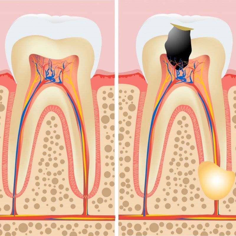 Подробно о том, как проводится депульпация зуба перед протезированием