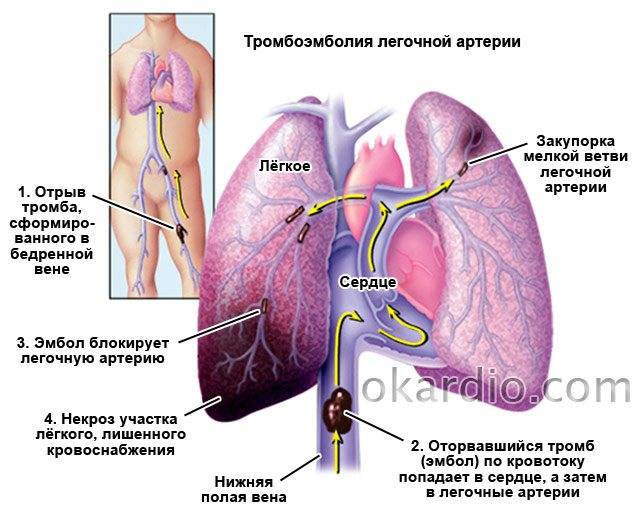 Тромбоэмболия легочной артерии (тэла)
