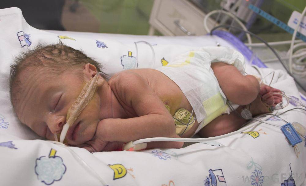 Врожденная пневмония у новорожденных – причины и последствия, сколько лечится