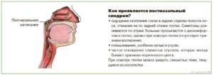 Неприятные ощущение кома в горле (давит): причины, что это может быть, лечение