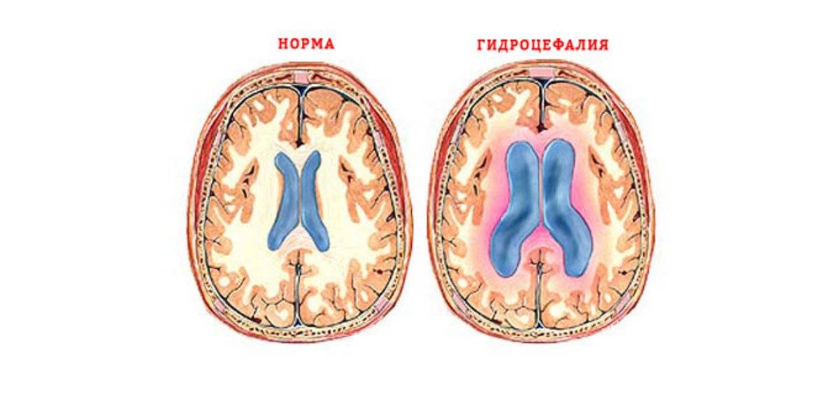 Что такое гидроцефалия головного мозга у взрослых?