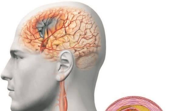 Спазм сосудов головного мозга: симптомы, методы лечения, профилактика
