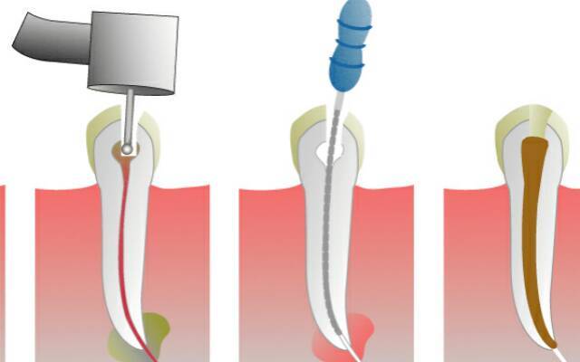 Умерщвление зуба перед протезированием – необходимость, мера предосторожности или неоправданный шаг?