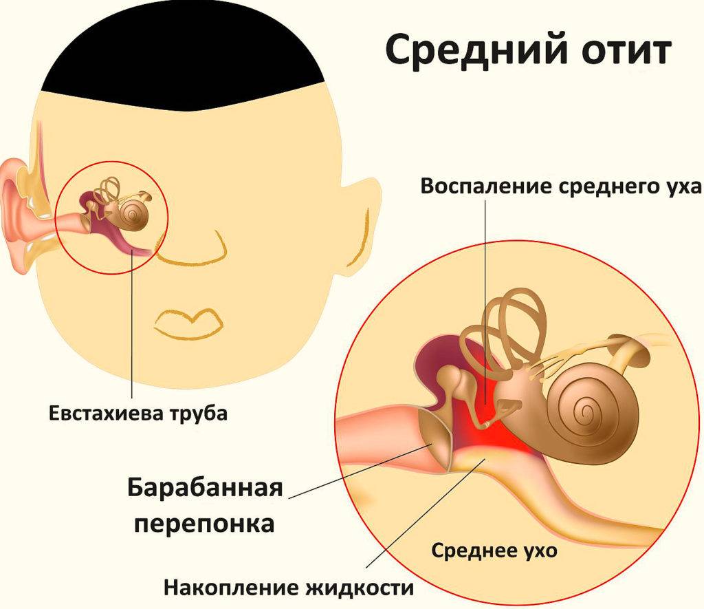 Что делать, если заложило ухо у ребенка и как его лечить