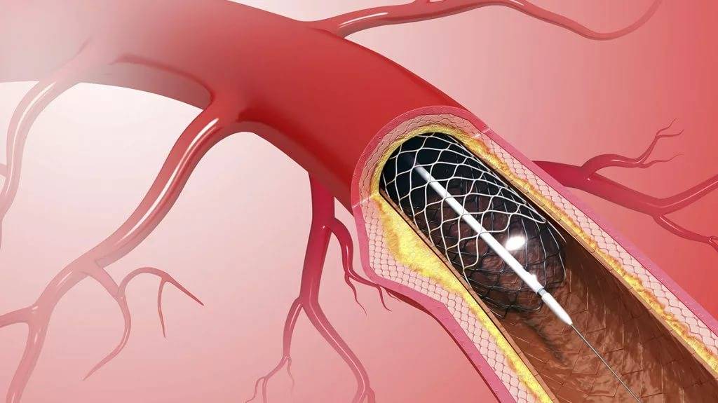 Операция по стентированию сосудов сердца (коронарных артерий): когда нужна, проведение, результат