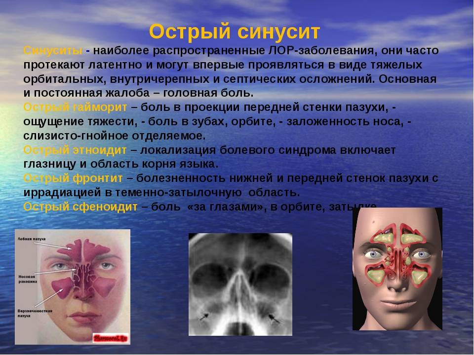 Гайморит - психосоматика у взрослых, причины кисты в пазухе носа, синусит по синельникову у ребенка, фронтит, как вылечить отек носа в домашних условиях