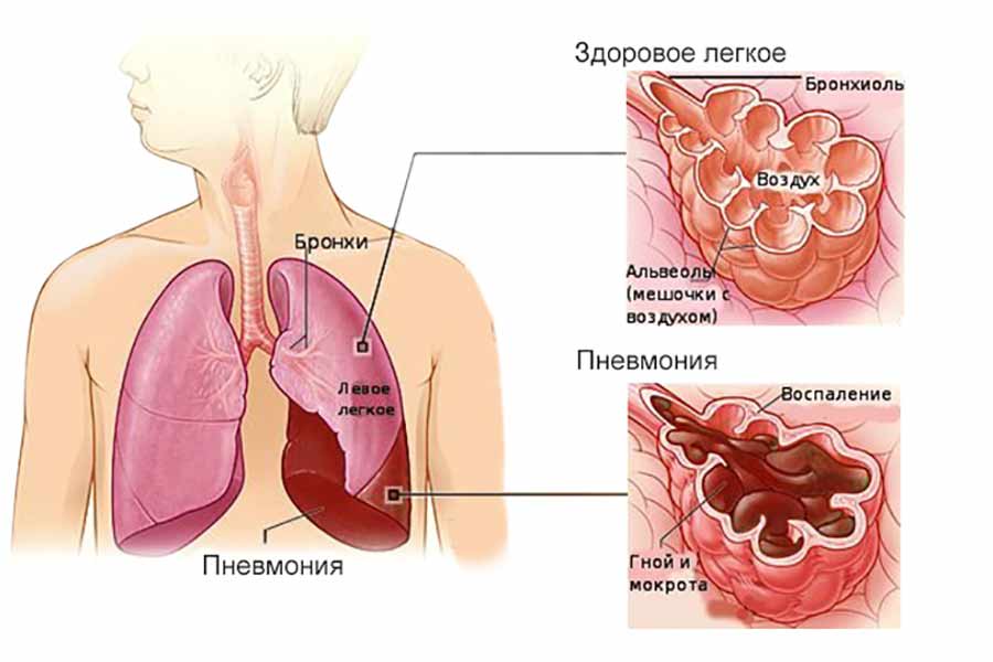 Пневмония у детей: симптомы, признаки и лечение