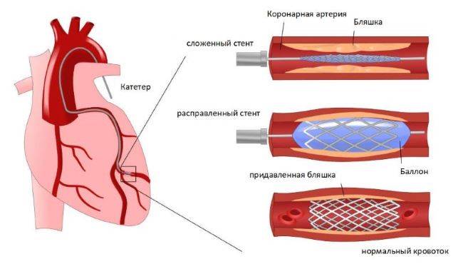 Восстановление и жизнь после стентирования коронарных артерий