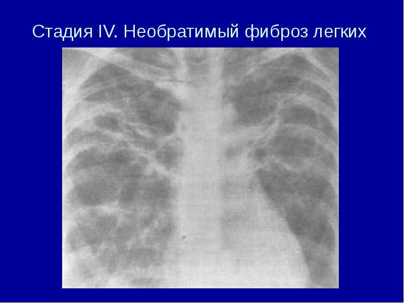 Фиброз легких: как лечить, что такое фиброзные изменения в легких, продолжительность жизни - medside.ru