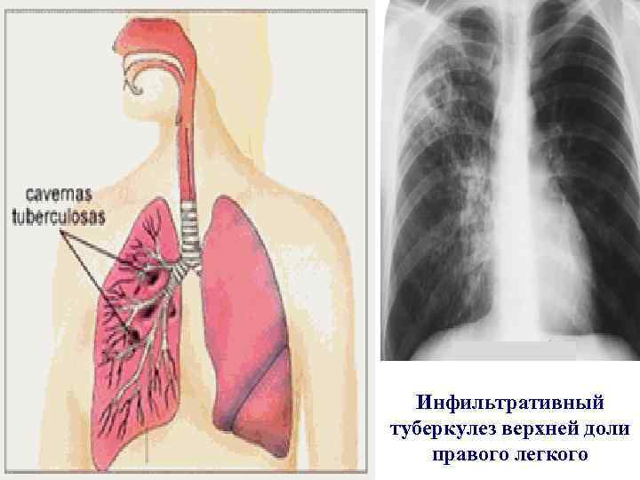 Инфильтративный туберкулез легких: заразен или нет?