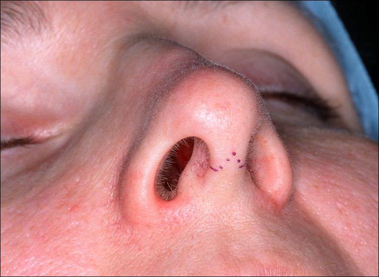 Полипы в носу у ребенка: симптомы и лечение