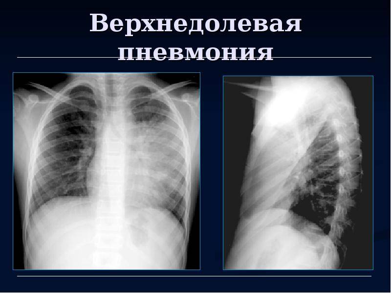 Правосторонняя пневмония: причины воспаления легких справа, лечение верхнедолевой и нижнедолевой пневмонии