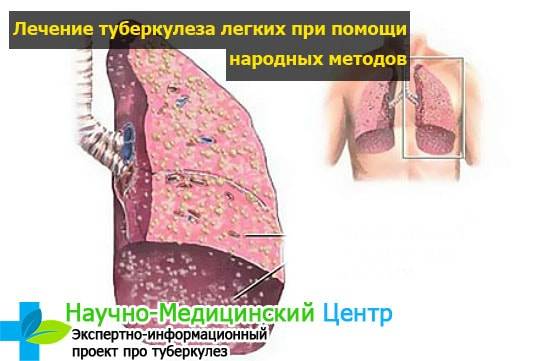 Лечение туберкулеза в домашних условиях