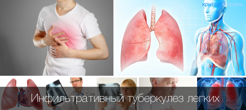 Туберкулез: лечится или нет и можно ли полностью вылечиться?