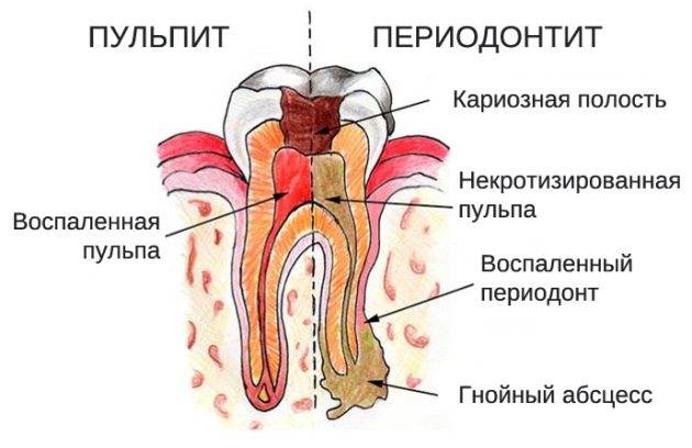 Узнаем, что такое депульпирование зуба