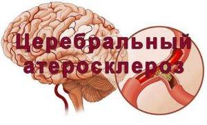 Склероз сосудов головного мозга симптомы лечение у пожилых - cardiologiy