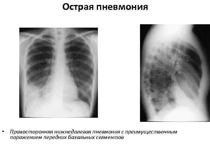 Очаговая пневмония: формы и лечение | pnevmonya.ru