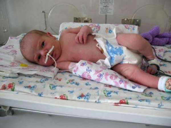 Внутриутробная пневмония у новорожденных