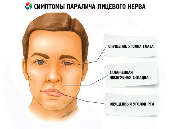 Неврит лицевого нерва, симптомы и лечение в домашних условиях