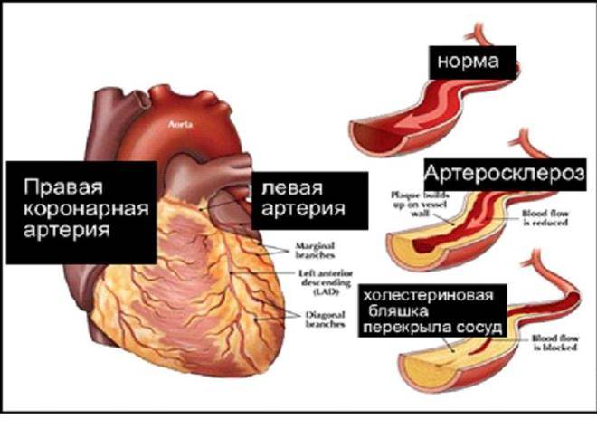 Диагноз атеросклеротический кардиосклероз | лечение сердца