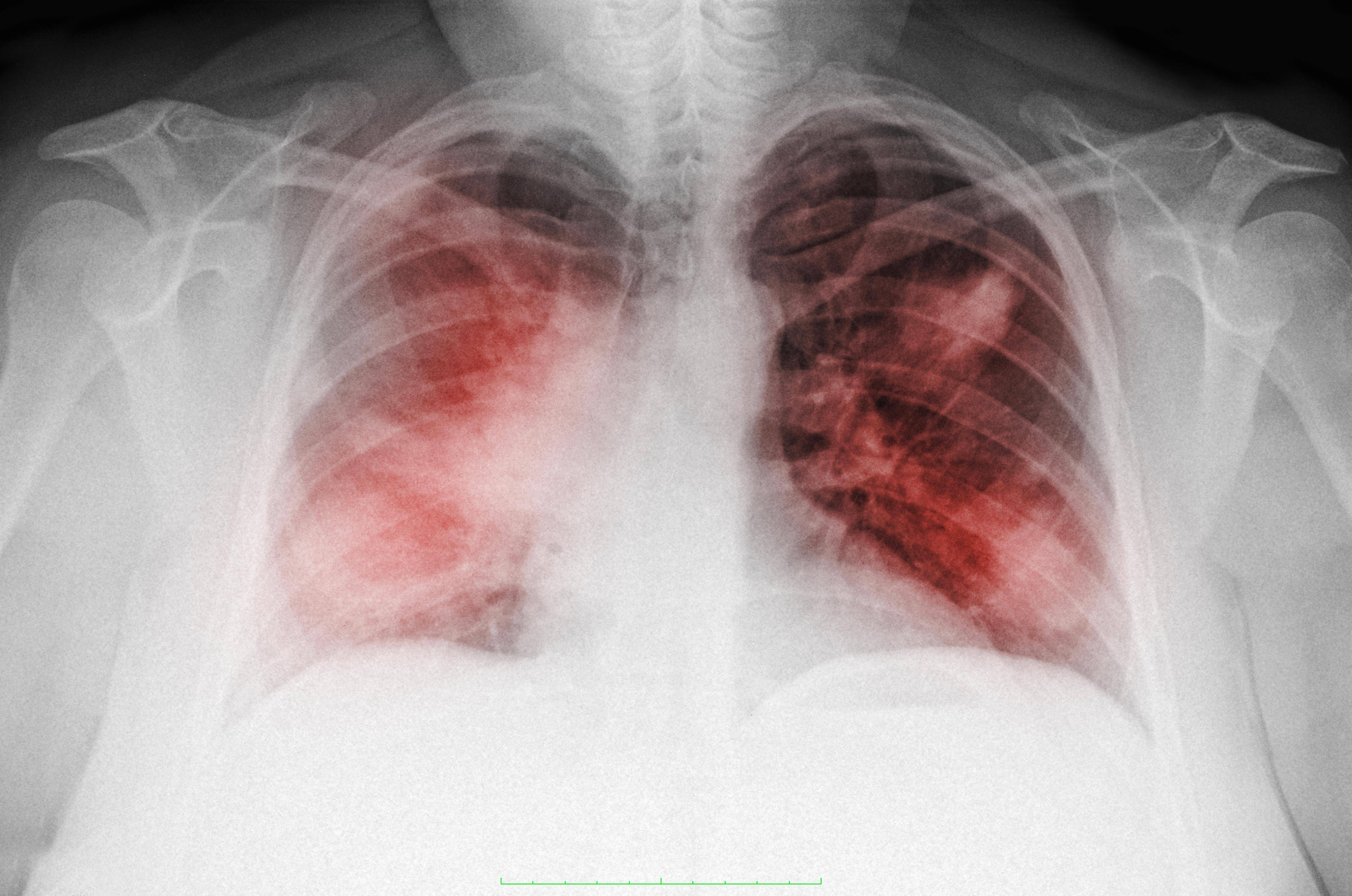 Двусторонняя нижнедолевая пневмония: особенности диагностики и лечения
