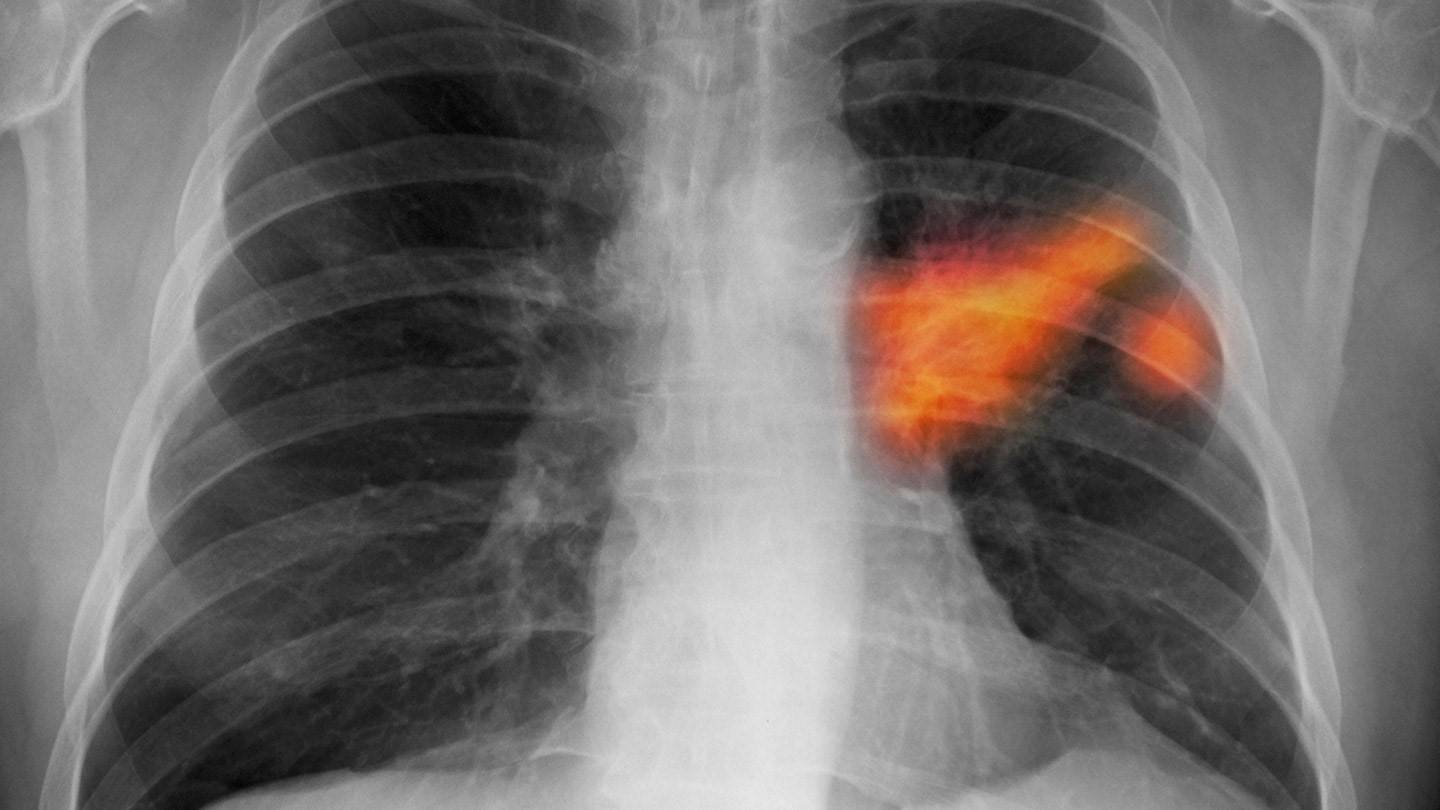 Пневмония и рак легкого: взаимосвязь и отличия
