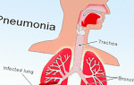 Может ли пневмония перейти в рак легких – как отличить воспаление от онкологии