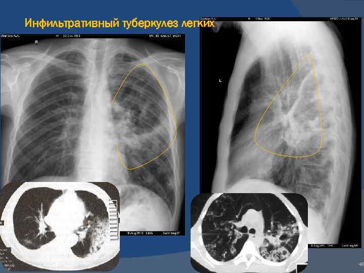 Диагностика и лечение очаговой формы туберкулеза легких