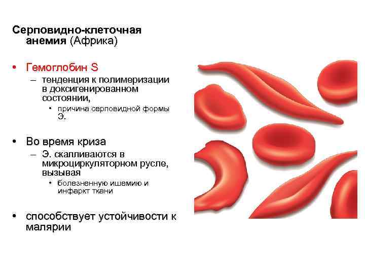 Серповидно-клеточная анемия