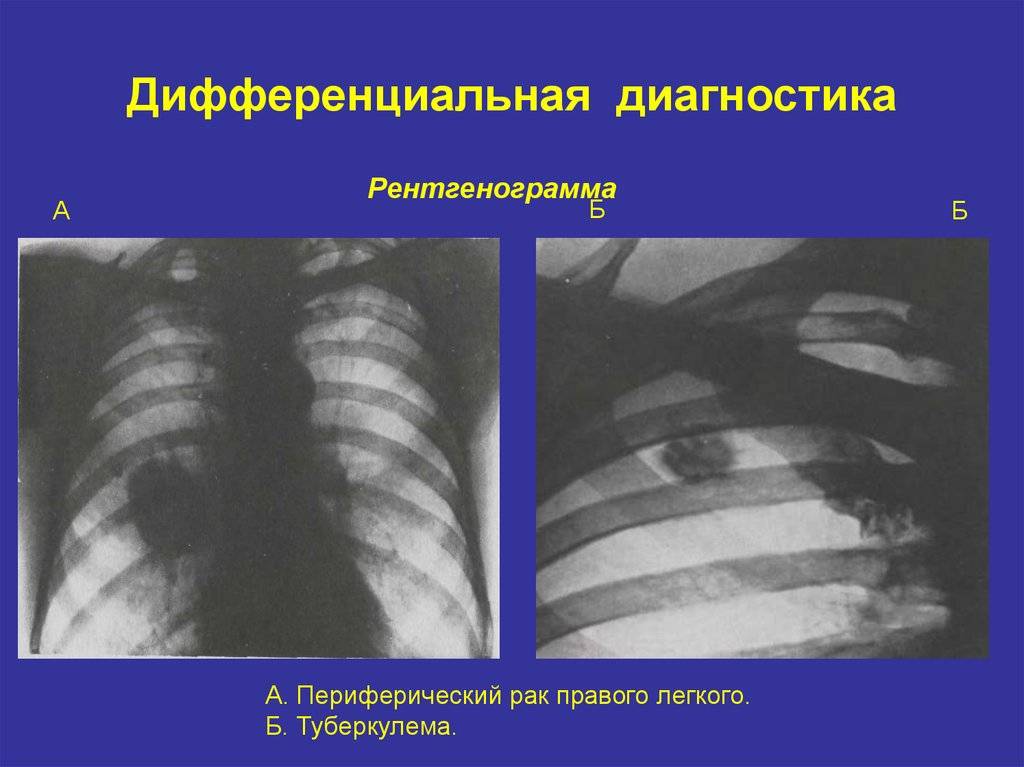 Дифференциальная диагностика милиарного туберкулеза